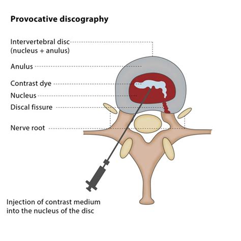 discography synonym|discography definition anatomy.